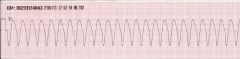 Rate: 101-250 bpm
Rhythm: regular ventricular rhythm
P Waves before QRS: no
PR interval: not measurable
QRS complexes look alike: yes, wide and bizarre