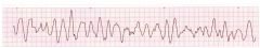 Rate: Not discernable
Rhythm: rapid, unorganised
P waves before QRS: no
PR interval: none
QRS complexes look alike: none