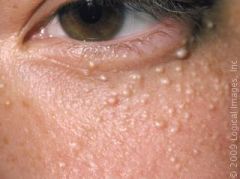 Milia (image)
Acne flares
Erythema beyond 2 weeks
Herpes simplex infection
Hyperpigmentation