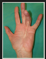 Shortened and fibrotic hand flexor tendons are associated with alcohol abuse.