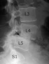 Shown here s spondylolithesis (which a bone (vertebra) in the spine slips out of the proper position onto the bone below it) 

Causes what clinical condition?