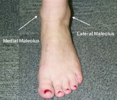 Cutaneous ulcerations and foot sores on the ankles at or below the level of the malleoli heels and tips of the toes