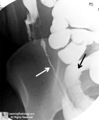 ileal or proximal small bowel disease with segmental narrowing of the ileum ("string sign") and longitudinal ulcers