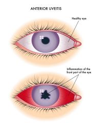 Redness of the eye
Blurred vision
Photophobia or sensitivity to light
Irregular pupil
Eye pain
Floaters
Headaches


Synechia = iris adheres to either the cornea