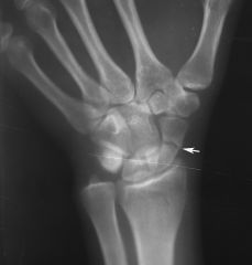 Fall onto hand when palm is abducted = _____________ fracture 

Proximal fragment may undergo ___________ 

Clinical signs: deep tenderness in anatomical snuffbox