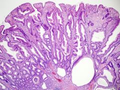 1. Represents 90% of all epithelial polyps and found in over half of all persons > 60 years of age


2. Composed of well-formed glands and crypts lined by crowded epithelial cells giving a serrated or saw-tooth look