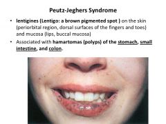 1. Rare Autosomal Dominant disorder 


2. Multiple polyps scattered throughout GI (most common-small intestine)


3. Hyperpigmentation of the oral mucosa, lips, face, and genitalia 


4. Increased risk of developing carcinoma of breast, pancreas, ...