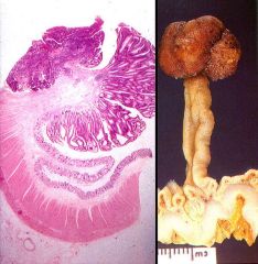 1. Most (90%) found in the colon and about half in the rectosigmoid 


2. Stalk composed of fibrovascular core covered by normal mucosa


3. Raspberry-like head composed of neoplastic epithelium, forming branching glands lined by cells w/ tall, hy...