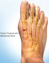 • Proximal articulations: Bases of metatarsals 2-5 articulate with each other Cuneiforms, cuboid