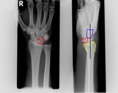 carpal tunnel syndrome. 

Often involves dislocation of LUNATE bone (outlined in red) & median nerve