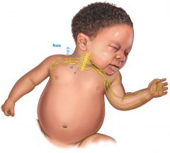 C5, C5 roots or SUPERIOR trunk -= upper brachial plexus 

Look how the c5, c6 is stretched :( in this super cute baby :( 

Note that over stretching causes the damage. So overstreching the left neck will cause symptoms on left side-- (paralysi...