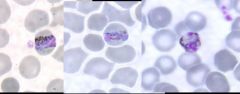 Infects mature RBCs, which appear normal sized
Has Ziemann's dots, but not Schuffner's dots
Trophozoite c banded, bar or round shape
Schizont c rosettes / irreg clusters of merozoites
Cyclic paroxysms every 72 hours
No true relapses, but may have...