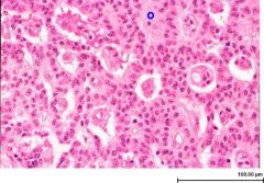 1. Solid, yellow-tan appearance on transection 


2. Monotonous w/ scant, pink granular cytoplasm & round-to-oval stippled nuclei