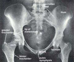 POSTERIOR hip dislocations most common. 

This is a fracture of the ISCHIUM

Femoral head is driven POSTERIORLY out of the acetabulum & tears the ISCHIOFEMORAL lig. 

This leads to shortening & medial rotating of the limb.