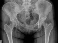 Say you're shadowing in ER.  Patient comes in, after a head on collision while a front-seat passenger. He's clutching his hip. You know enough to suspect a hip dislocation involves the femur. (That's something...) 

If you had to pinpoint it dow...