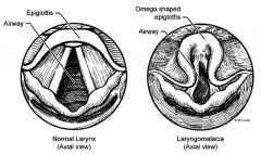 congenital
most freq cause of stridor in infants/kids
starts first 2wks of life

surgery = supraglottoplasty