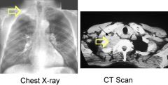 A tumor at this site (apex of lung) may result in what syndrome? 

What will be symptoms  patient may exhibit?
