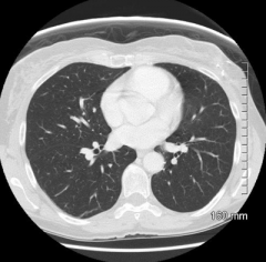 - CT 
- MRI (but not used very often in evaluation of pulmonary infections)