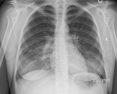 What is the diagnosis of this chest x-ray? What clues?