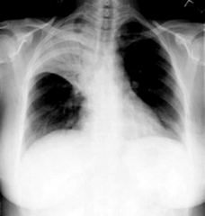 Lobar Pneumonia in RUL
- Minor fissure is elevated
- RUL is full of pus and has collapsed
- Can't see mediastinum on R side because of a soft tissue-soft tissue interface
- Linear lucencies in RUL = air bronchograms (patent air waves)