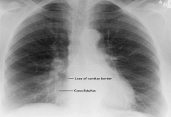 RML infiltrate pneumonia (loss of cardiac border on R side, the RML is adjacent to R heart border)