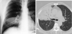 What is the diagnosis of this chest x-ray / CT? What clues?