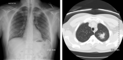 This patient was treated with antibiotics, but still has this notable infiltrate on chest x-ray and CT. What is the diagnosis?