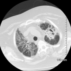 Aspirgillosis infection - mass is an Aspirgilloma 
- If you moved the patient around and re-imaged them the Aspirgilloma would move around whereas a tumor would not