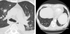What is the diagnosis of this chest CT? What clues?