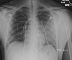 46-yo male w/ AIDS. Presents w/ low grade fever and cough. Hypoxic. Chest radiograph shows minimal patchy densities. 

Next test?