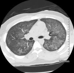 What is the diagnosis of this chest CT? What clues?