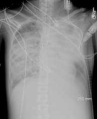 Acute Respiratory Distress Syndrome
- Overwhelming pneumonia that wasn't treated soon enough
- Extensive, diffuse infiltrates on both sides
- Air bronchograms
- Pleural effusion