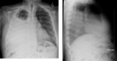 What is the diagnosis of this chest x-ray? What clues?