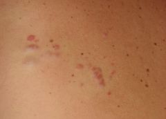 A patient presents with tender papules with a pseudo-Dariers sign.  She has other family members with the same condition.  Screening should be performed to rule out which malignancy?