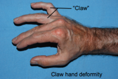 "Claw hand"
Hypothenar (pinky muscles), Interossei, and Lumbricals 3&4 //all innervated by deep branch of ulnar nerve
Unable to flex at MCP joint