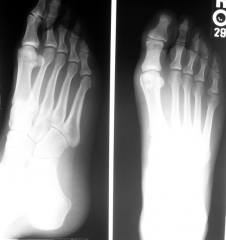 Cuboidal in ankle and wrist; only in carpus and tarsus
Examples: scaphoid, cuneiforms