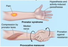 Median nerve ENTRAPMENT
mechanical work 
Compression between heads of the pronator teres
pain and tenderness in proximal anterior forearm
hypoesthesia/hypesthesia in the palmar part of lateral 3.5 digits