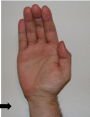 "Ape hand" deformity