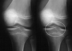 Fracture de l'épine tibiale
si déplacée: réduction + consult ortho
si non-déplacée: immobilisation + suivi ortho