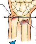 Complete transfers fracture of  DISTAL RADIUS STYLOID and distal  ULNA styloid aversion.
distal radial fragment is displaced DORSALLY

most common forearm fracture
median and ulnar n injury
associated with carpal fx, dislocation of radioulnar join...