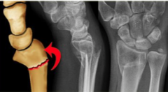 Smith fracture