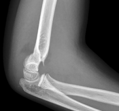 6 year old girl fell on outstretched hand. X rays shown. How do you treat?