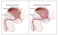 Its an enlarged  prostate gland . The prostate gland surrounds the urethra, the tube that carries urine from the bladder out of the body. As the prostate gets bigger, it may squeeze or partly block the urethra. Its related to age. 