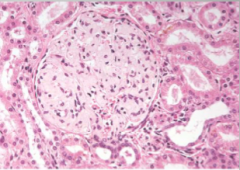 what is accumulated in this glomerulus