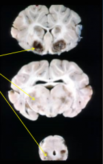what type of necorsis is indicated by the arrow and what is this called in the CNS