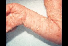 What are the Sx of  transient neonatal pustular melanosis? Tx?