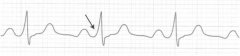 Delta wave with widened QRS complex and shortened PR interval → SVT