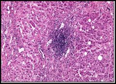 -panlobular infiltration w/ mononuclear cells

-hepatic cell necrosis

-hyperplasia of kupffer cells

-variable cholestasis
