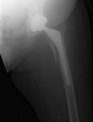 60 year old patient 5 weeks out after left total hip. How do you manage this fracture? 