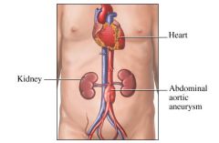 Abdominal aortic aneurysm typically occur just above the bifurcation at the level of L4 & cross by the third part of the duodenum. 

Pulsation of a large aneurysm can be detected to the LEFT of the midline at the umbilical region. 

Don't be t...
